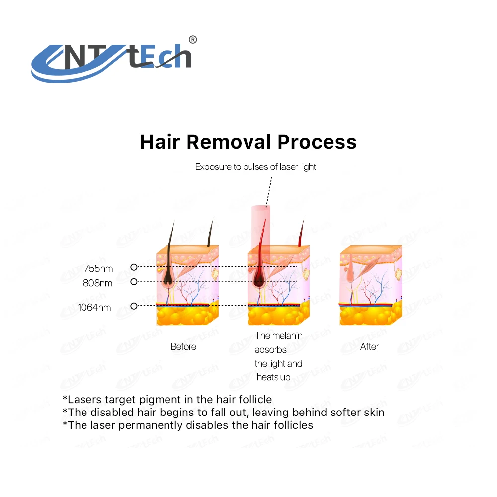 Home use diode laser hair removal device for bikini legs arms face body painless hair remover