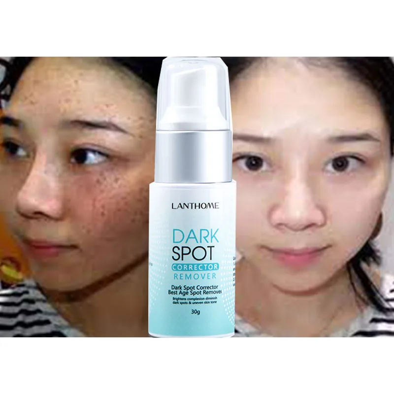 OEM 30g Natural Herbal blemish Serum Freckle Pimples Dark Spot Removal Corrector Eraser Whitening Cream