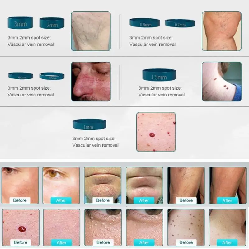 Professional Spider Vein Removal Blood Vascular Removal 980 Diode Laser Machine For Varicose Veins Treatment