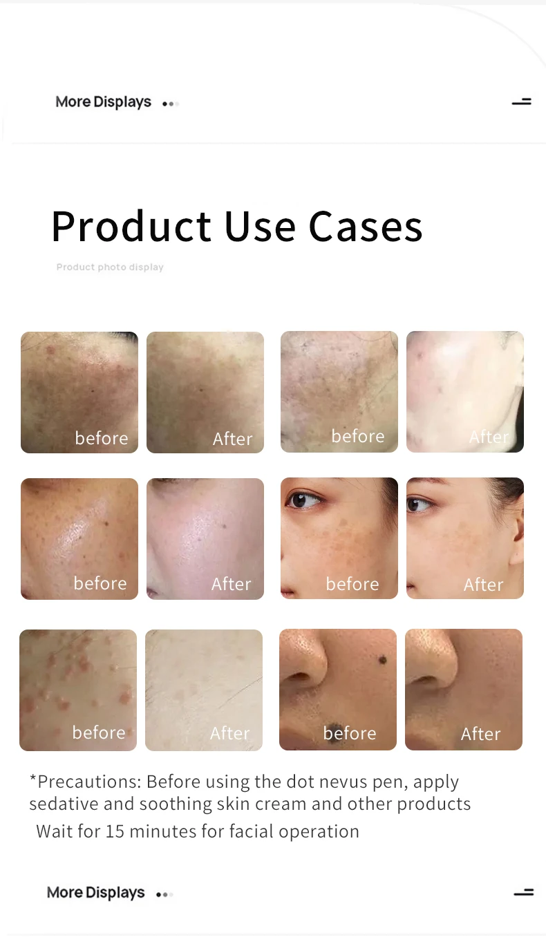 2023 Multifunctional Plasma Pen Beauty Remove Skin Remove Spots Beauty Salon Instrument