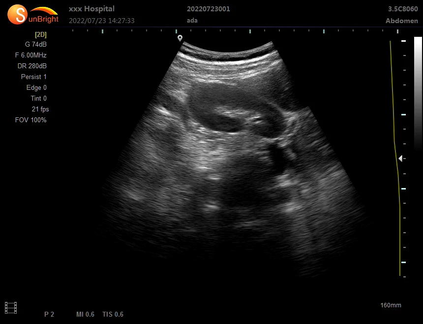 SUN-806H professional small 2D black and white ultrasound scanning blood vessel medical machine