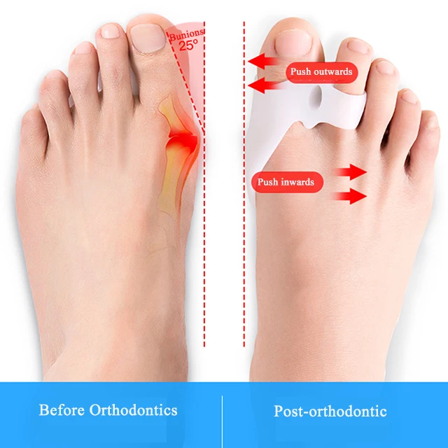 Bunion Лечение 2 шт протектор для пальцев ног гель разделитель для пальцев