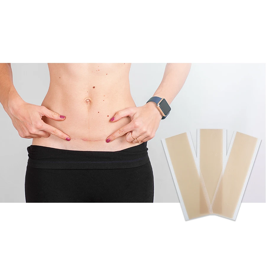 2025 New trend best-selling surgical scar removal patches Scar patches are effective in removing scar patches