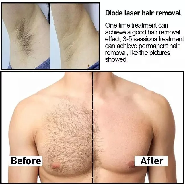 2022 Newest Ice Platinum XL diode laser 755 808 1064nm standard ICE diode laser hair removal machine price