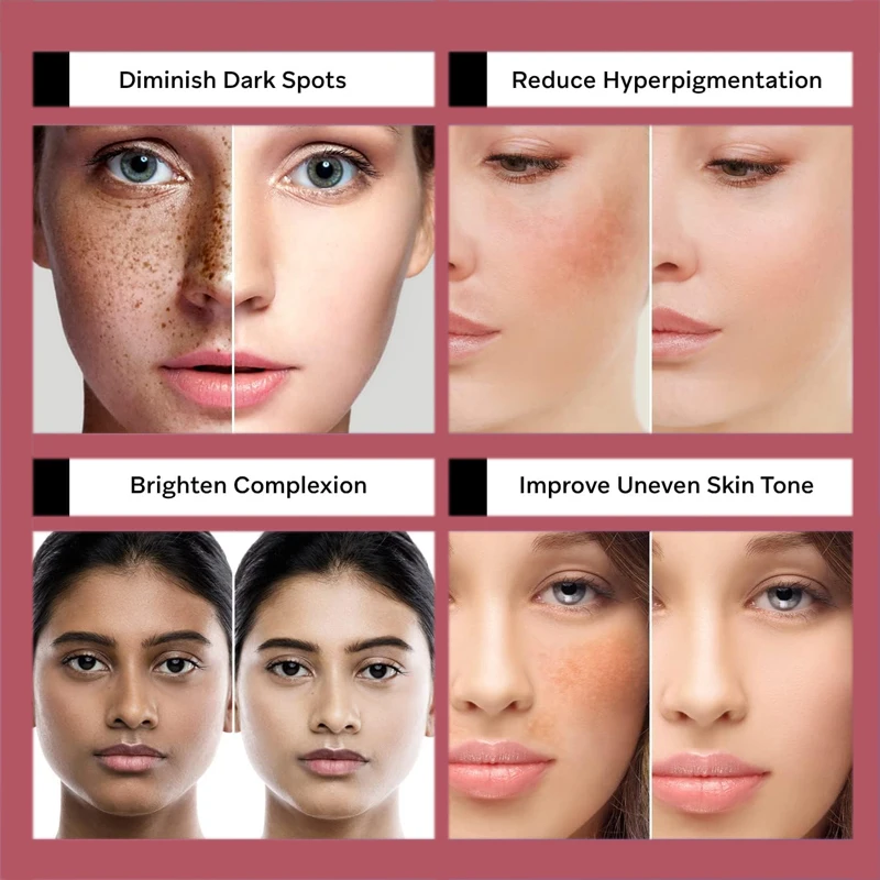 Pigmentation Removal Cream Brightening Skin Nourishing Whitening Organic Dark Spot Remover Bleaching Cream