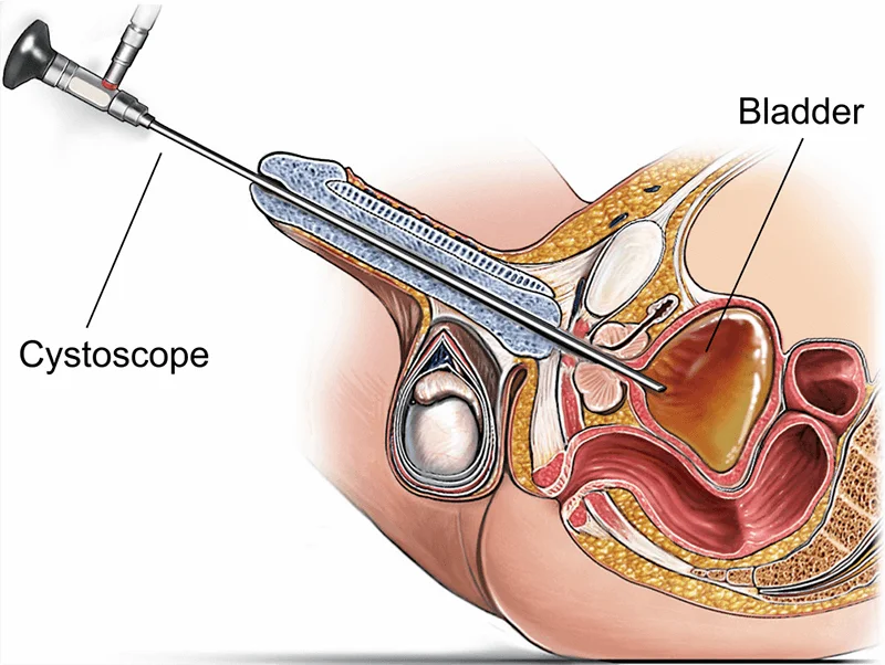 Cystoscope NP-3X (Child type), Urological surgical instruments