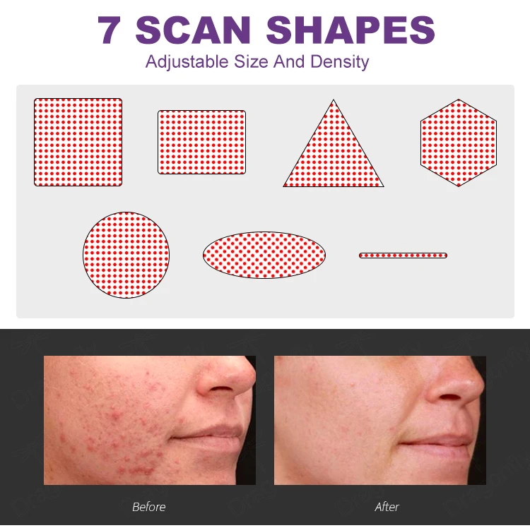 co2 laser system laser vaginal tightening and rejuvenation wand nd yag laser