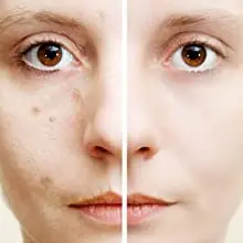  Private Label Natural Skin Care Plant Acne Treatment 10% Vitamin C Serum For Pimple Face