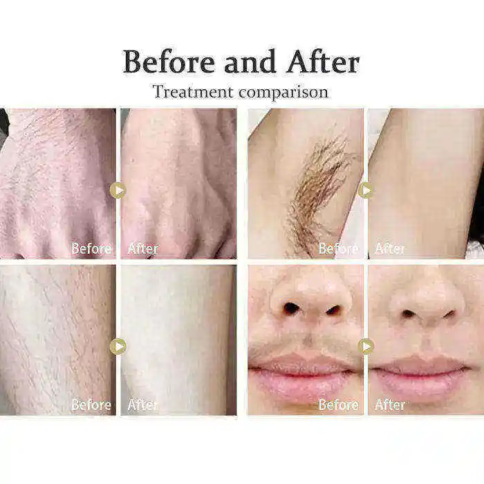 2023 New Design Painless Whole Body Skin Care Hair Removal 808 Nm Permanent Laser Machine Epilator Price