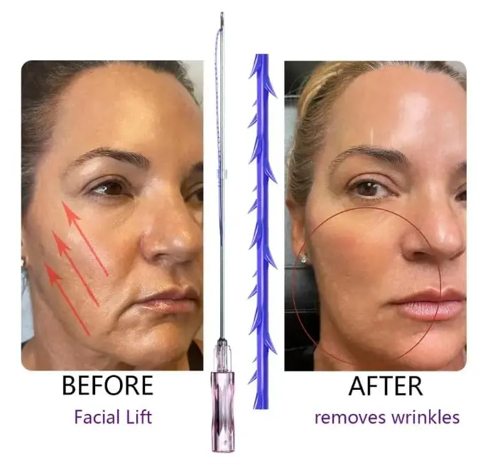 REJEON pdo thread lift korea 3d 4d 6d cog pdo  thread lift face pdo faden nadel