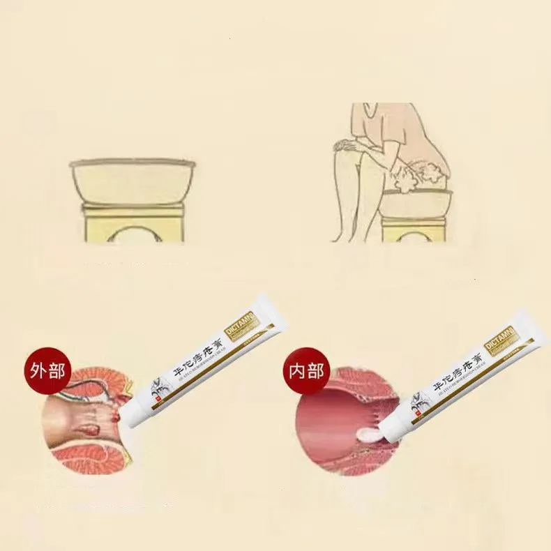 OEM can effectively treat hemorrhoids, internal hemorrhoids, external hemorrh Huatuo Hemorrhoid Cream