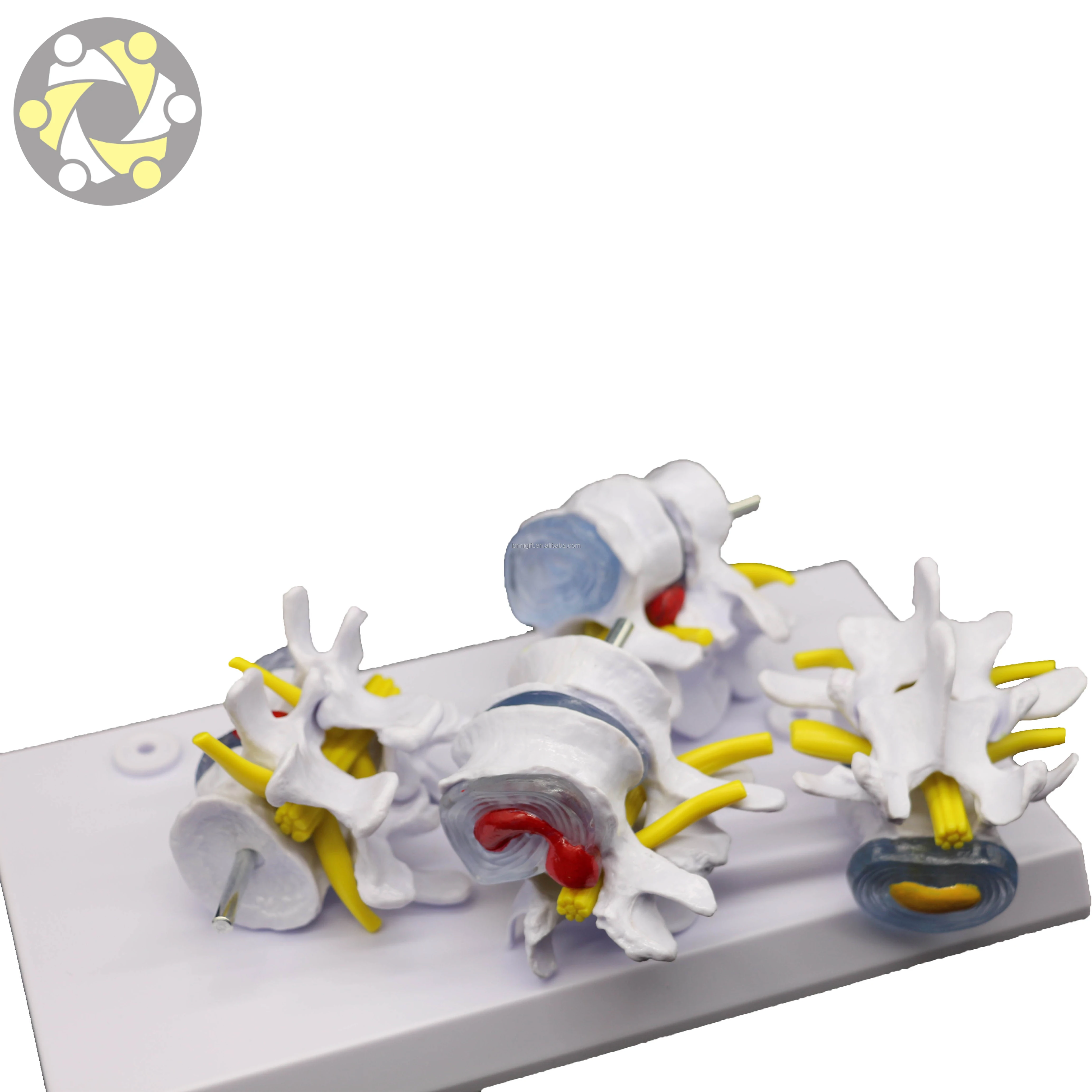Medical Science 4 Stage Pathological Lumbar Skeleton Model