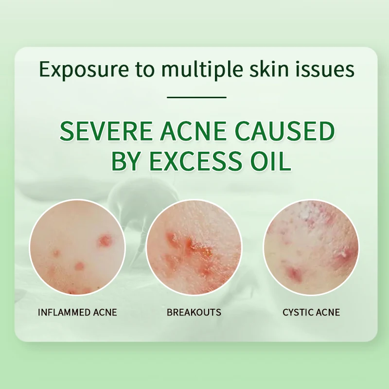 Deep clean dirt and acne Clean pores improve stains Moisturize skin anti acne face cream acne removal korean
