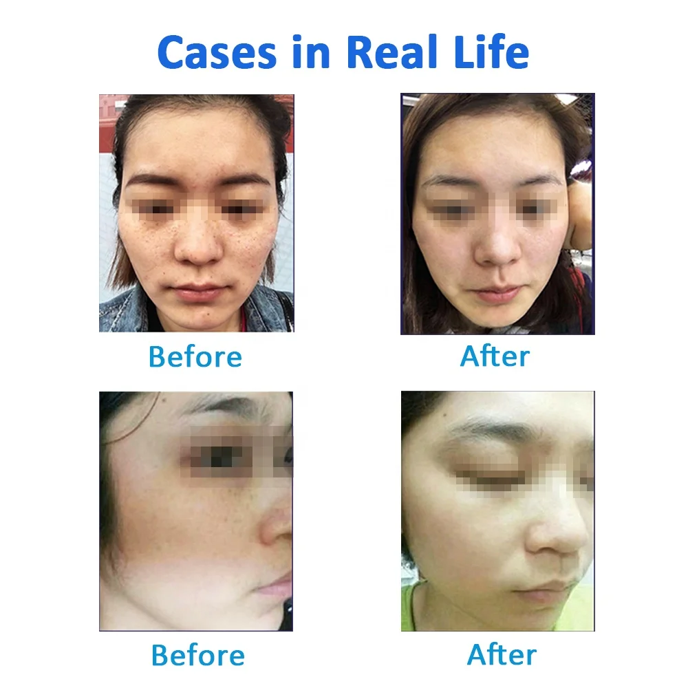 
New Skin Care Machine Beauty Equipment / Hydra Microdermabrasion Facial Machine 