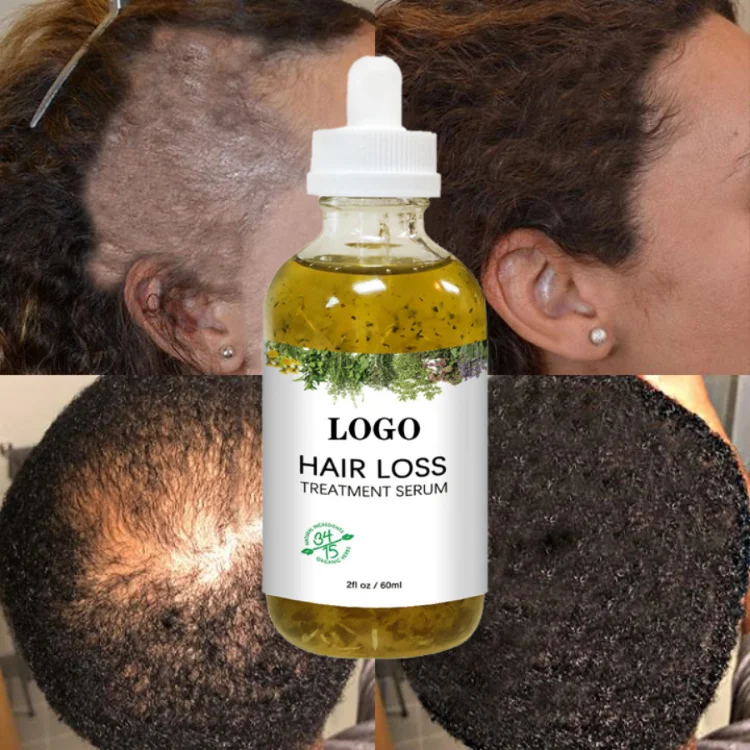 60ml Fast Hair Regrowth Serum Black Seed Castor Hair Growth Serum Oil Thick Hair Fast Growth For Black Women_14