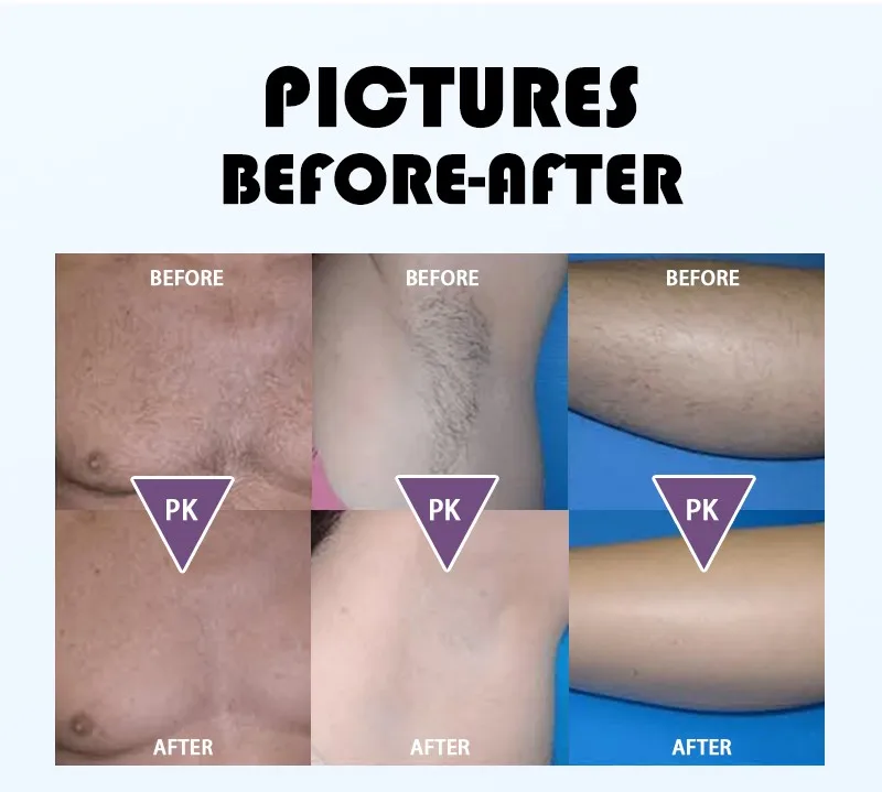 Weifang Huamei Portable IPL filters ipl hair removal ice cooling professional ipl machine