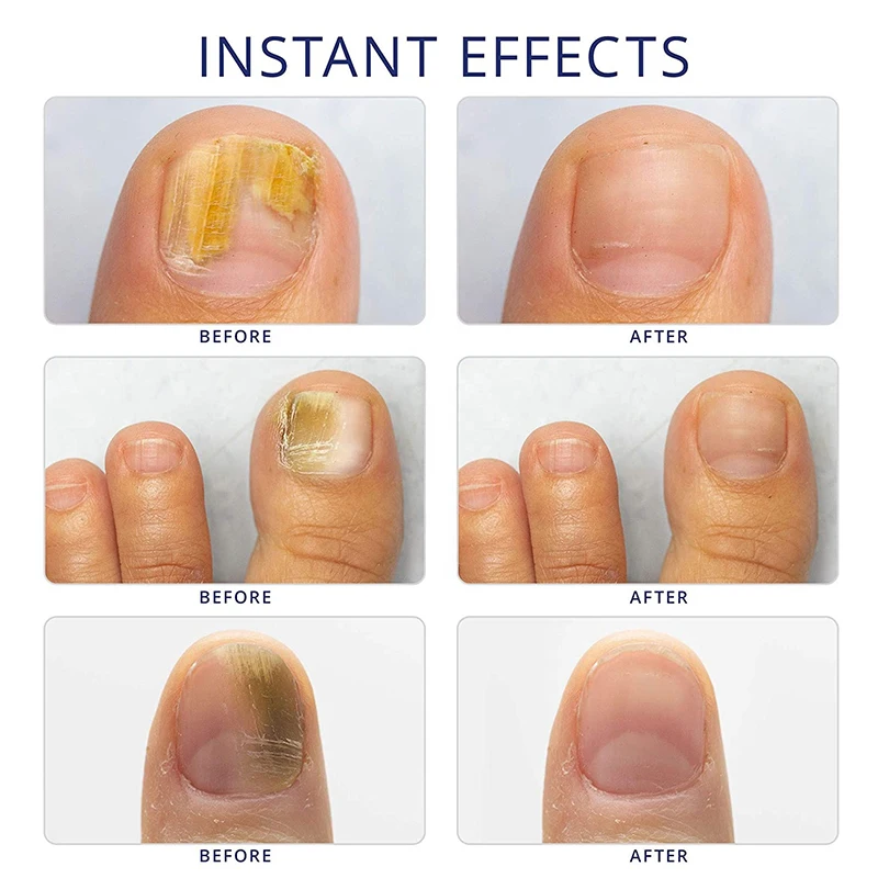 Foot Care Best Treatment Fungus Infection Remedies Liquid Toe Nail Fungus Treatment Fungal Nail Repair -281151