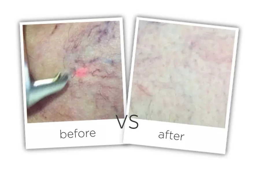 Berylas 1470nm diode laser for spider vein removal/vascular surgery EVLT device