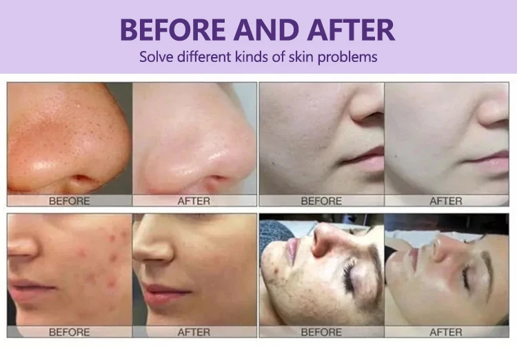 Кислородные пузырьки для лица