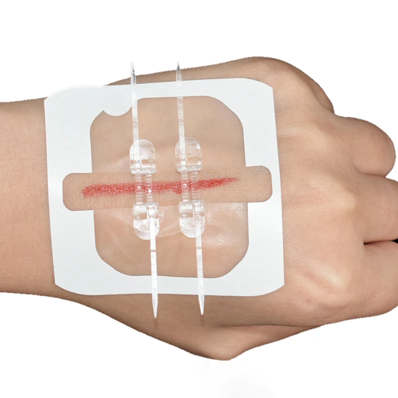 Устройства для сращивания РАН устройства ран работы