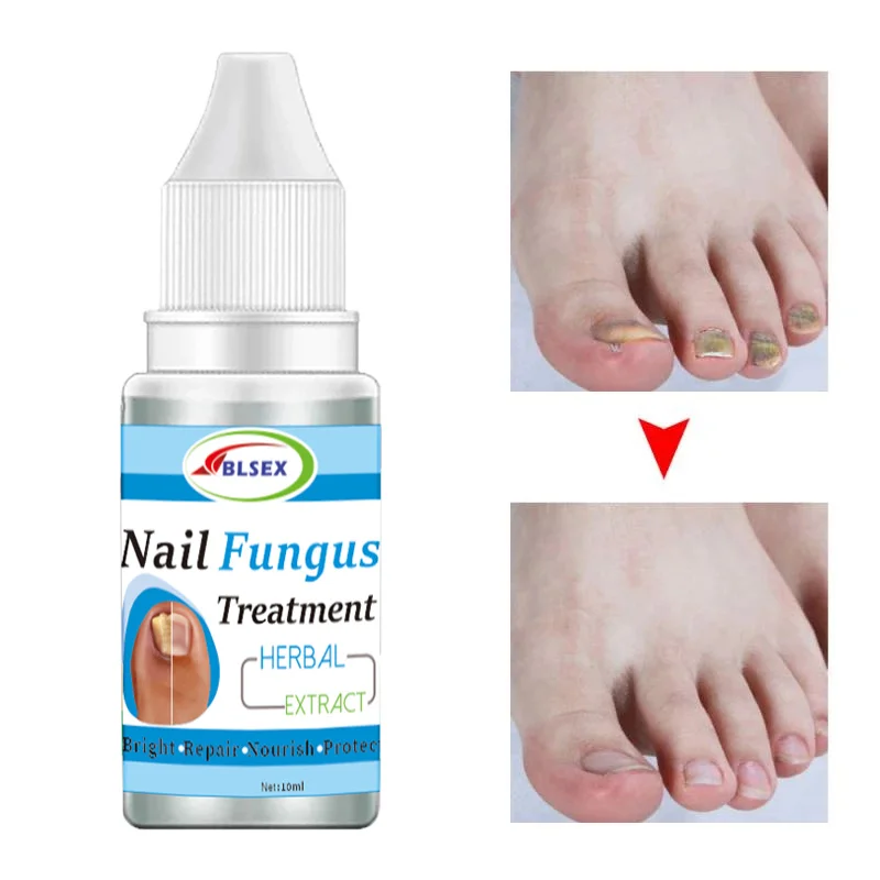 Antifungal Nail Solution for Nail Fungus Treatment Healthy Toenail Growth Repair Fluid with Toe Nail Care Treatments