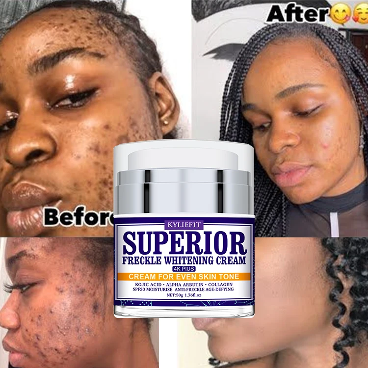 Private Label Face Black Freckle Acne Fade Dark Spot Removing Corrector melasma pigmentation removal Whitening Cream