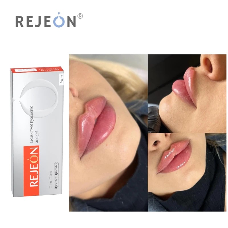 REJEON hyaluronic acid filler injection deep hyaluronic acid gel 10ml derm for lip enlargement  injection