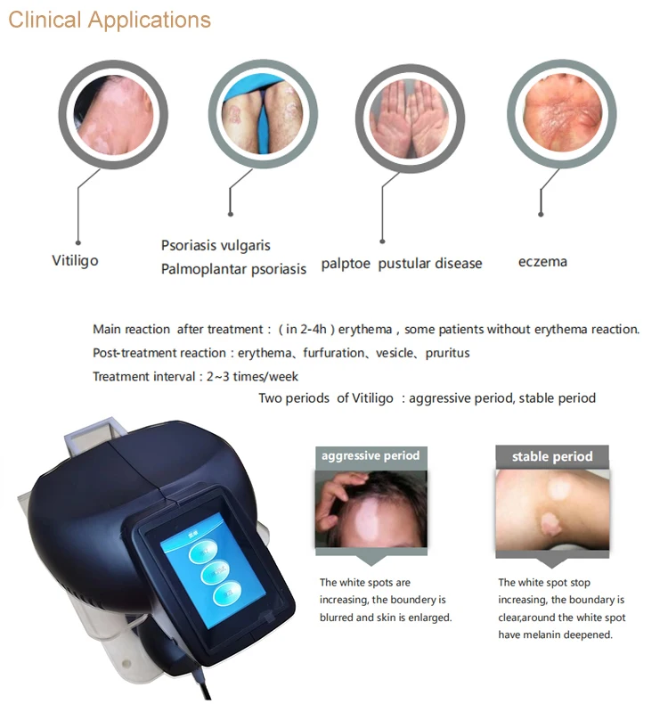 Led Popular 2023 For Oil Vitiligo Monobenzone Cream For Vitiligo Heshun Treatment 308nm Uvb Eximer Laser Vitiligo Psoriasis