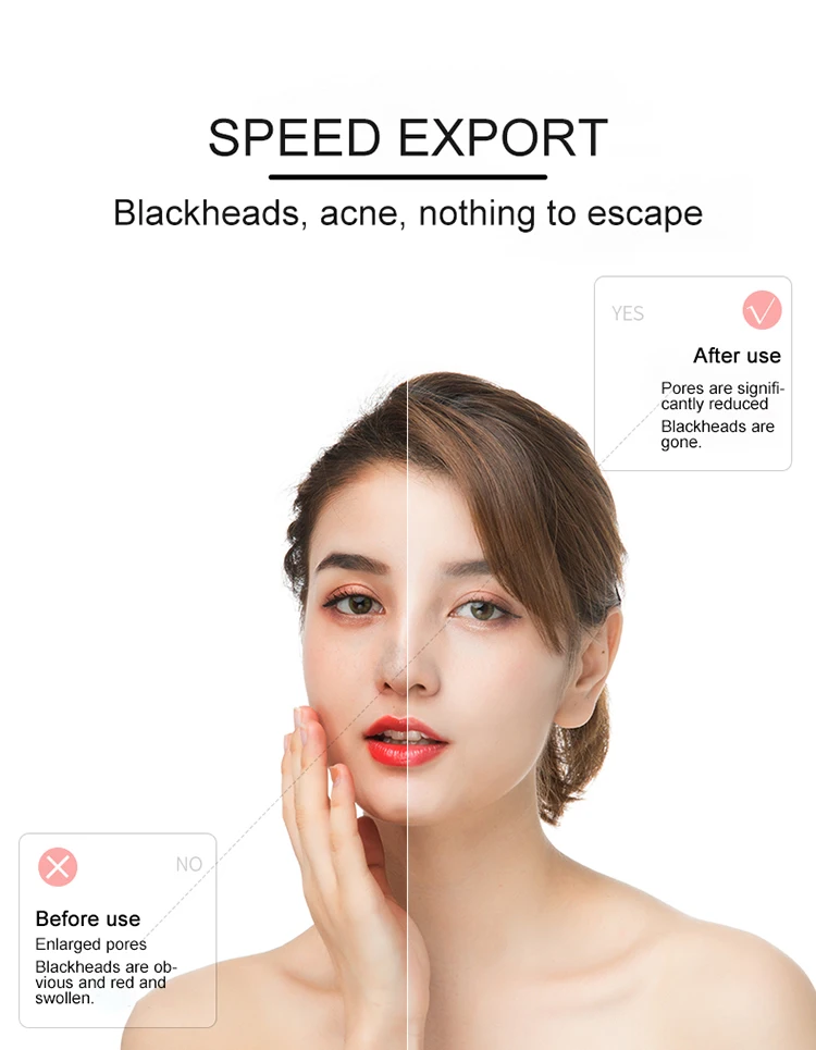 Аппарат для удаления пятен и акне, вакуумное устройство для очищения пор, электрический прибор для удаления черных точек, массажа лица, с пятью присосками bl