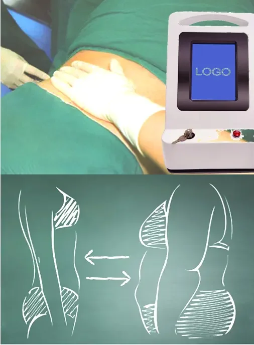 Laser lipolysis Fat Liposuction 980 nm Diode Laser With 1064 nm NdYAG Laser