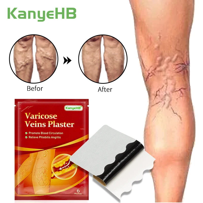 6pcs Treatment For Varicose Veins Plaster Chinese Herbal Varicosity Angiitis Removal Phlebitis Spider Leg Veins Pain Plaster