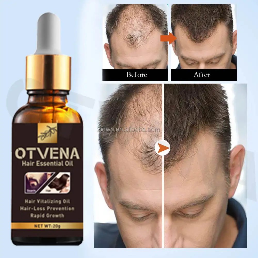 100% Guaranteed Satisfaction Ginger Oil Hair Growth Oil For Men Women Hair Growth