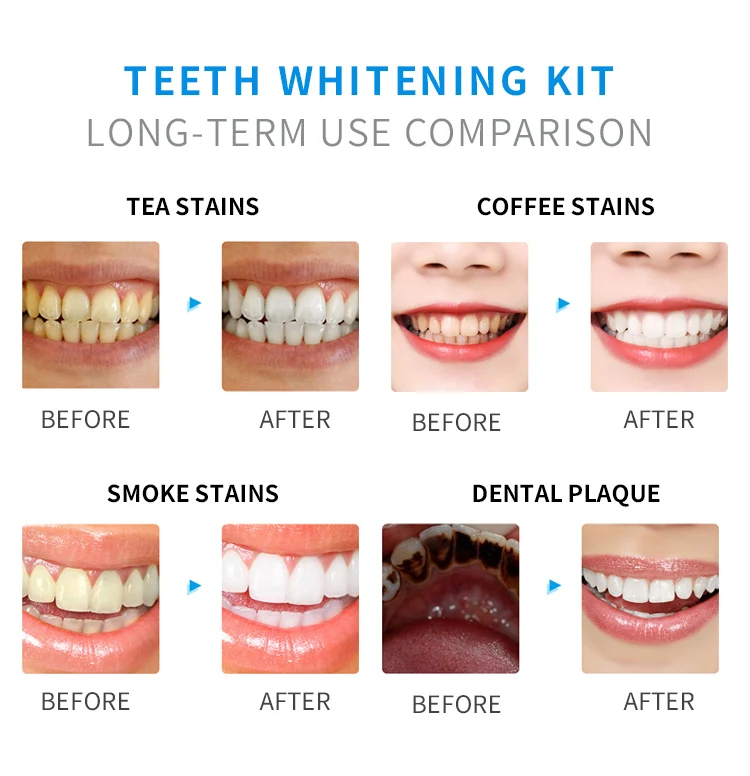 Tooth Whitening Gel Kit with LED Light Dental Peroxide Teeth Brightening Kits Teeth Whitening Pen Set