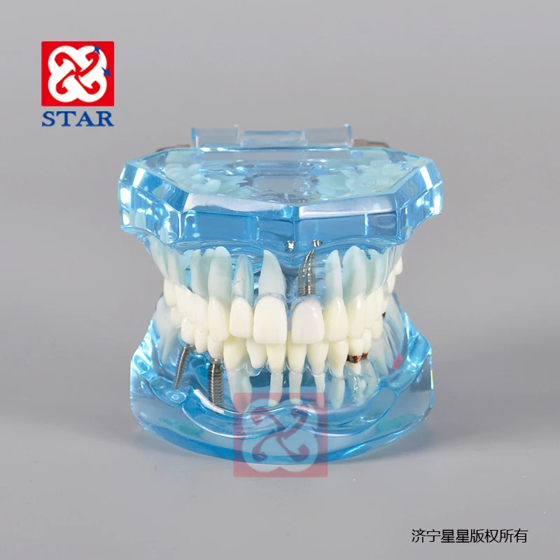 Implant restoration pathological dental model for demonstration