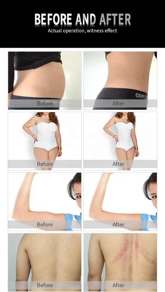 
Cellulite Removal RF Microwave Vacuum fat splitting system /Vacuum Therapy Massage Machine 