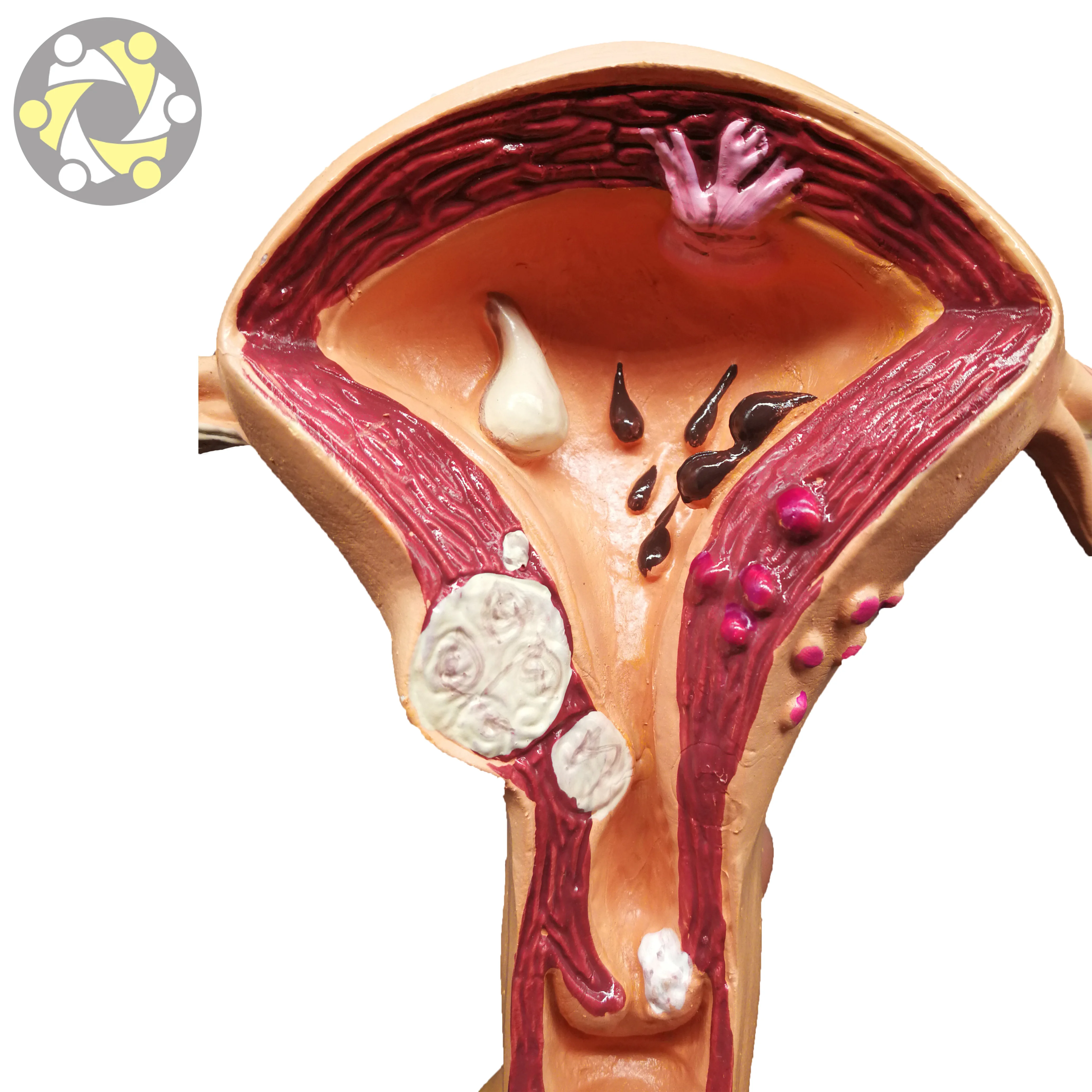 Female Uterine Fibroids Pathological Anatomical Model PVC Material for Medical Science and School Usage