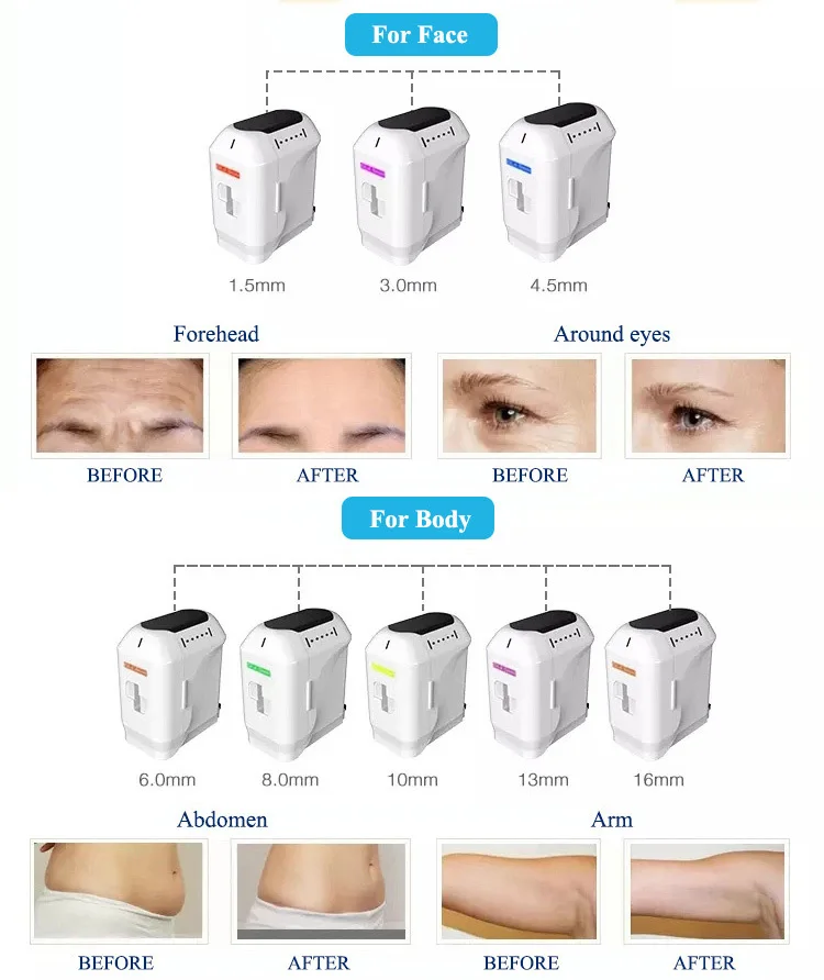 Mini 7D Hifu cartridges anti wrinkle 4d Hifu facial y corporal high intensity focused ultrasound hifu vagina 12d machine 2024