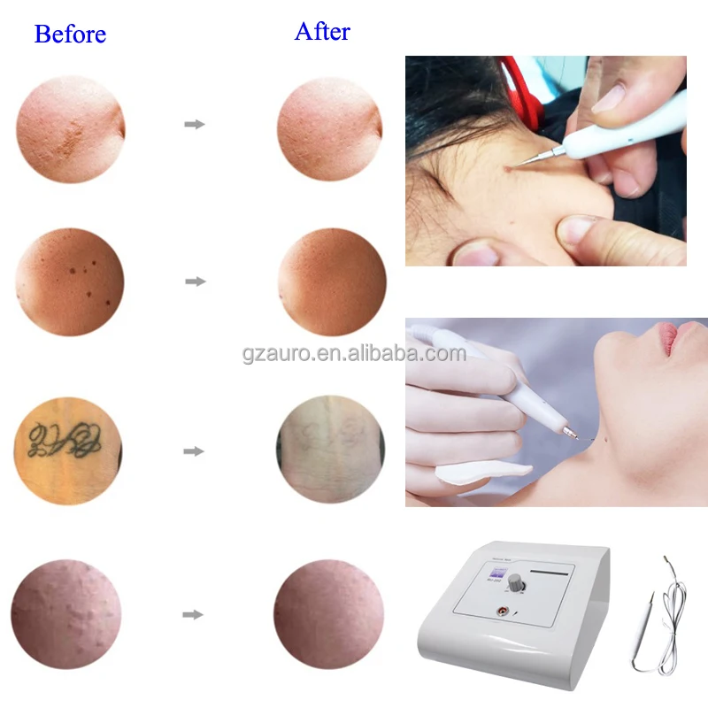 AU-202 Portable Skin Tag Removal High Frequency Cautery Beauty Skin Spot Removal Machine