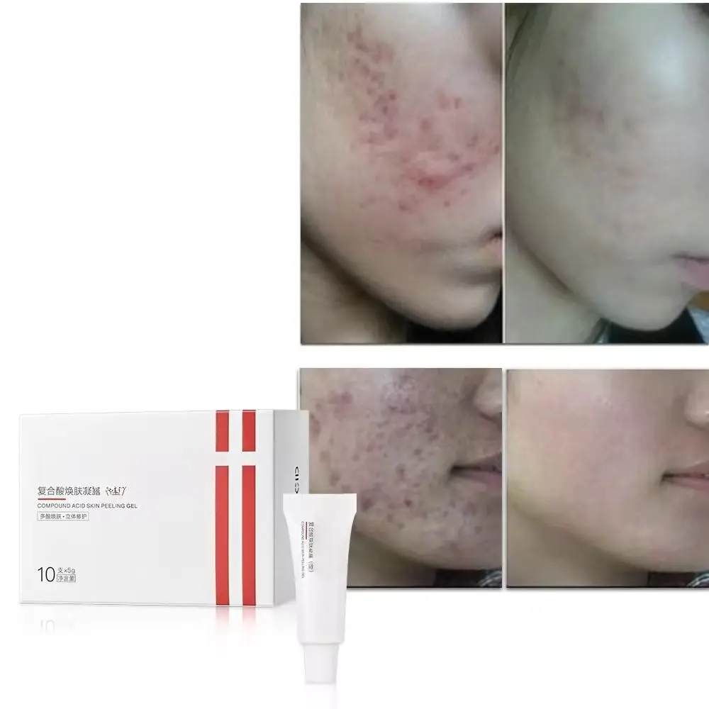 High Quality OEM Professional Beauty Salon Used 35% Anti Acne Aging Spots Mandelic Acid Salicylic Acid Chemical Peeling Gel