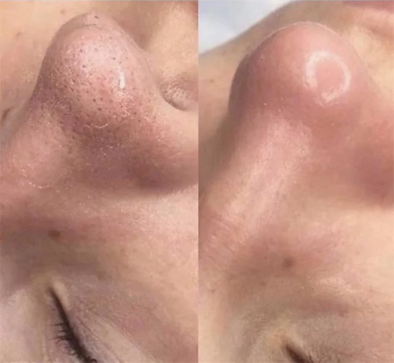 Wholesale In Stock Skin Care Beauty Face Care Remove Blackhead Acne Remover Clear Black Head Nose Strips