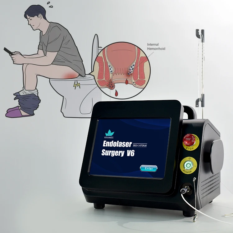 2025 new hemorrhoid surgery  laser  980nm 1470nm diode laser proctology hemorrhoids painless