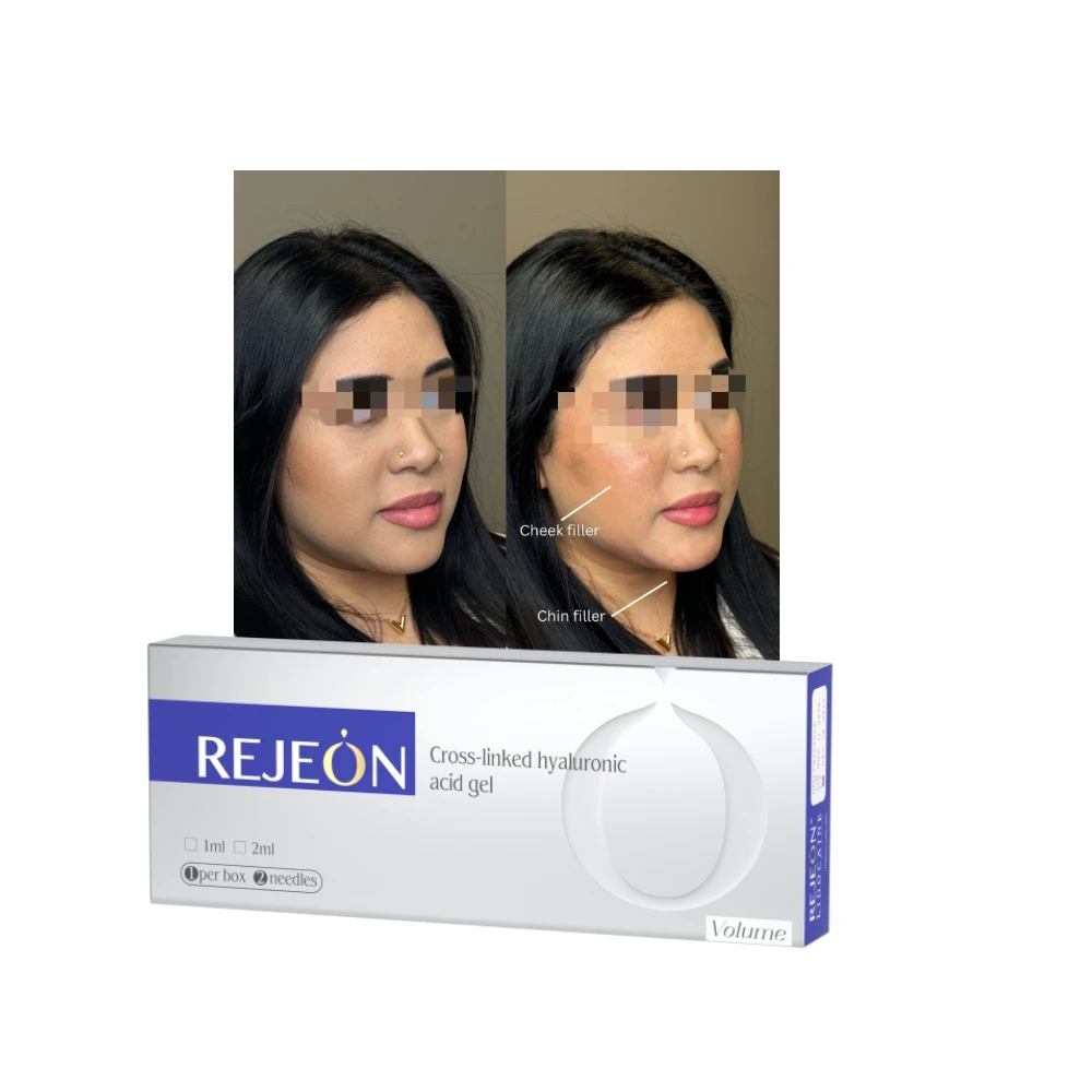 Neuramis HA Hyaluronic Acid Filler Dermal Filler Facial Filler for Forehead Nose Lips facial