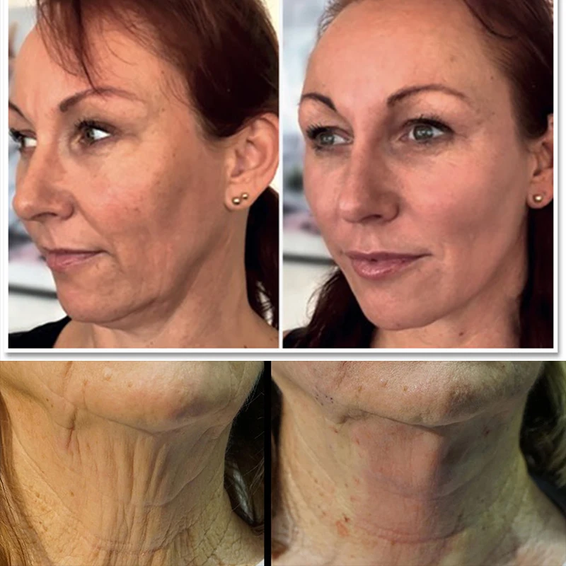 more powerful made korea easy operate lip contour face lift screw threads pdo tornado screw thread