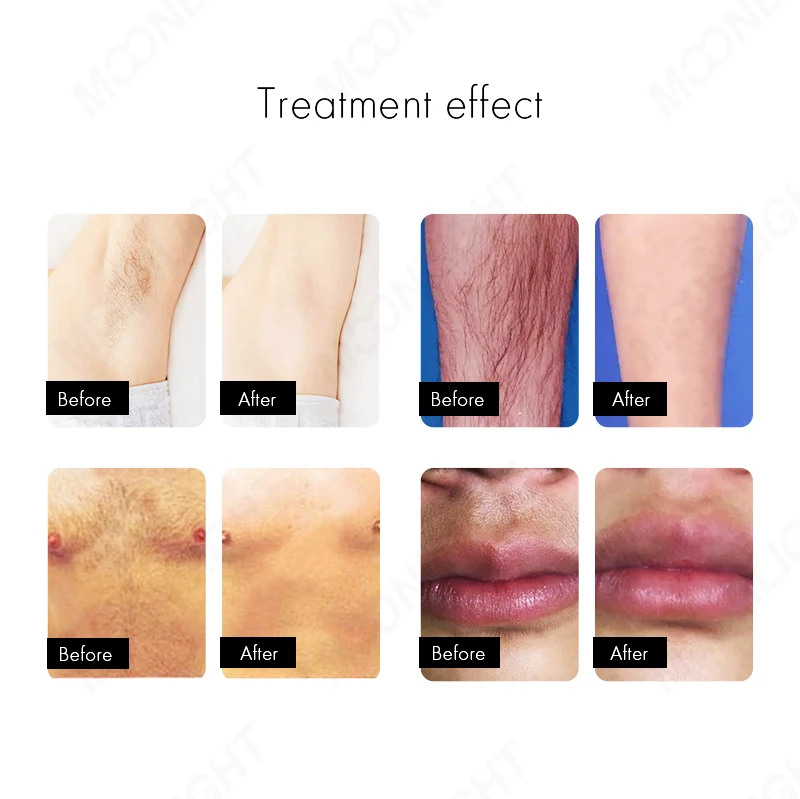 xenon laser lamp for 2 in 1 810nm 2023 oem 2 in 1 ipl diode laser hair removal machine cerr deka platinum ice ear