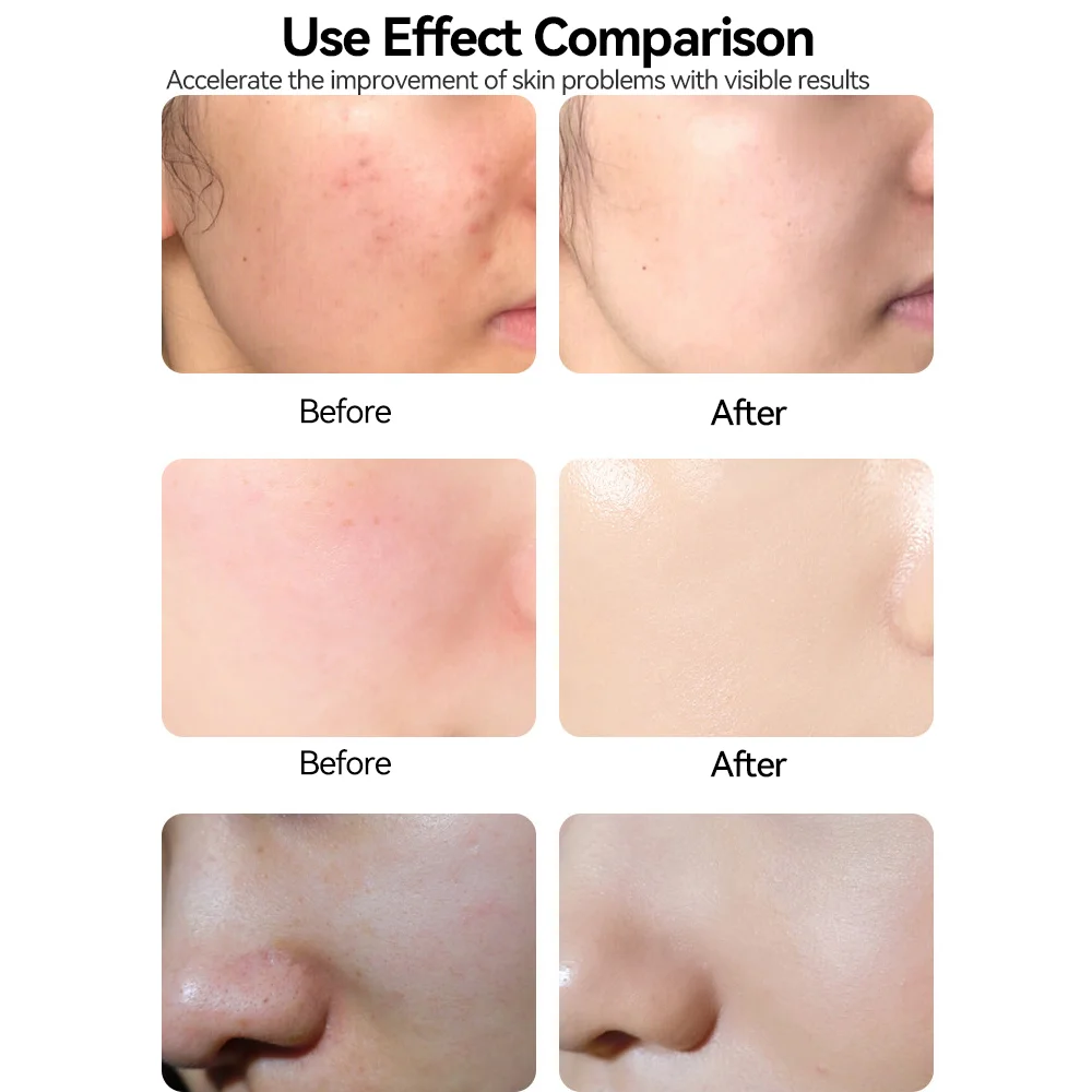 Nano Chip Derma Pen  Micro Needling Pen For Skin Derma Pen  Professional Nano Microneedle