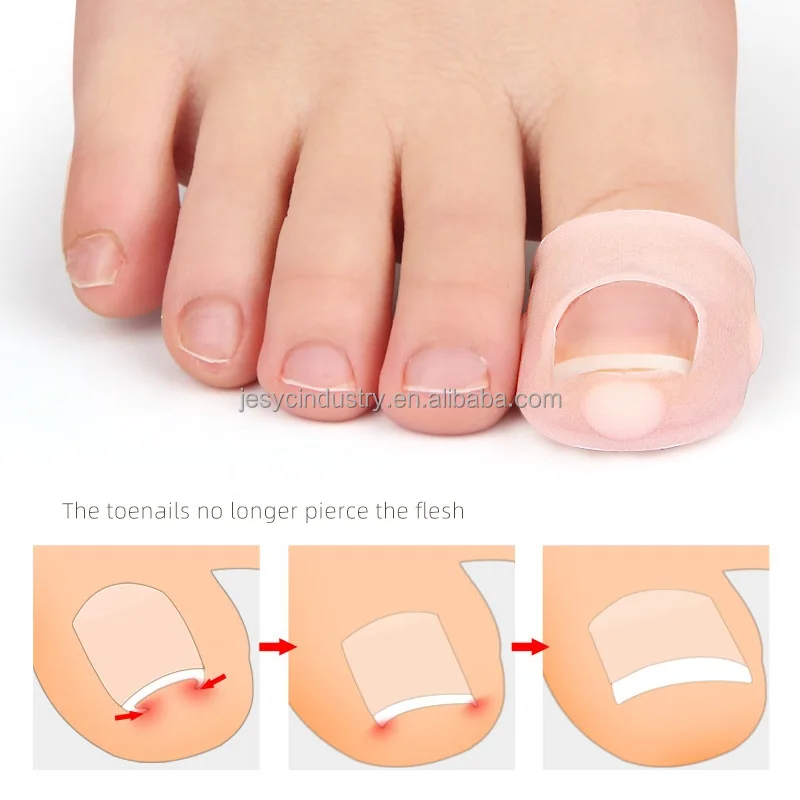 Foot Care Accessory Big Toe Nail Silicone Dot Corrector Ingrown Toenail Paronychia Treatment Tool Elastic Silicon Toenail Sleeve