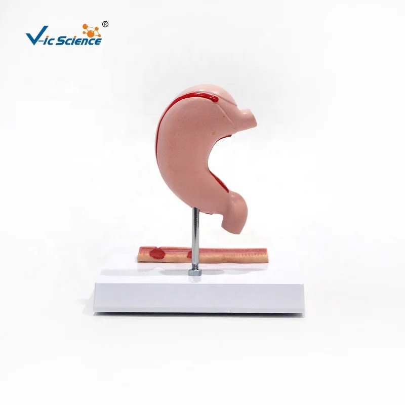 medical anatomical model Hot quality BN Plastic Stomach diseased  Gastric ulcer  anatomy model medical science education model