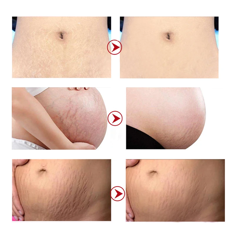 Private label stretch mark cream Eliminate stretch marks in one week Natural and organic asiaticoside stretch mark cream