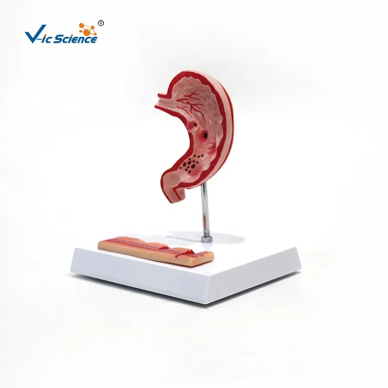 medical anatomical model Hot quality BN Plastic Stomach diseased  Gastric ulcer  anatomy model medical science education model