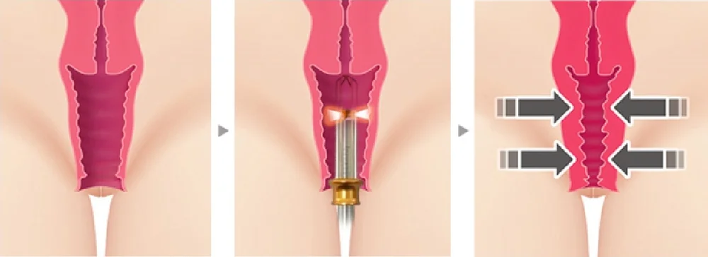 2024 Vaginal tightening machine gynecological physiotherapy Laser vagina rejuvenation 980nm 1470nm diode laser vaginal pain